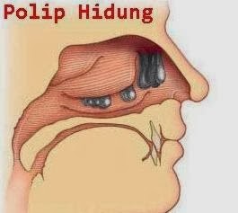 Cara Cepat Mengobati Penyakit Polip Cara Cepat Mengobati Penyakit Polip