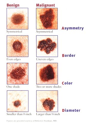 abcd melanoma abcd melanoma