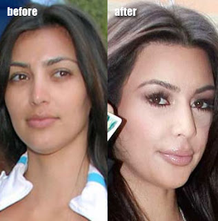Kim Kardashian Lips Injections