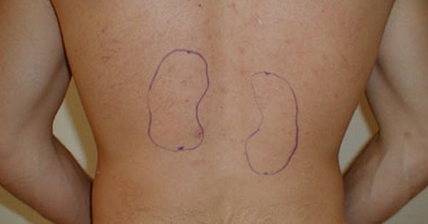 Kidney Pain : Location, Symptoms, Causes, Diagnosis, Treatment | i