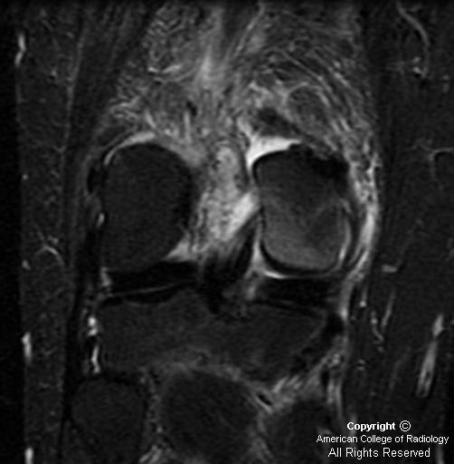 Insufficiency Fracture Coronal short T1 inversion recovery (STIR) image shows hypointense -4.bp.blogspot.com