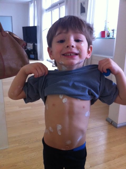 Three Foxes and a donkey...: Hello chicken pox!