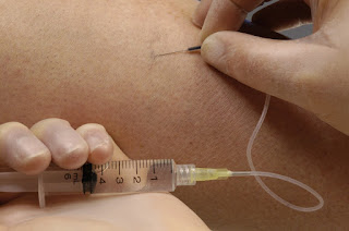 Escelerosis de varices