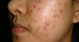 Salep Dermatix Ultra