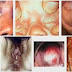 Obat Turuk Bernanah Kental thumbnail
