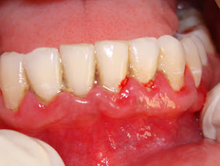 http://www.cosmodentists.com/general-dentistry-gum-surgery.html