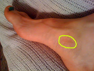 Accessory Navicular