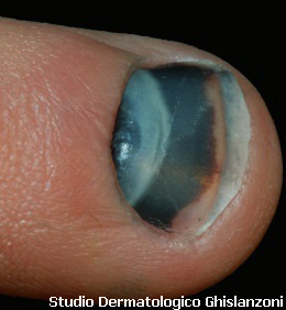 Fungo di specie Candida di medicina