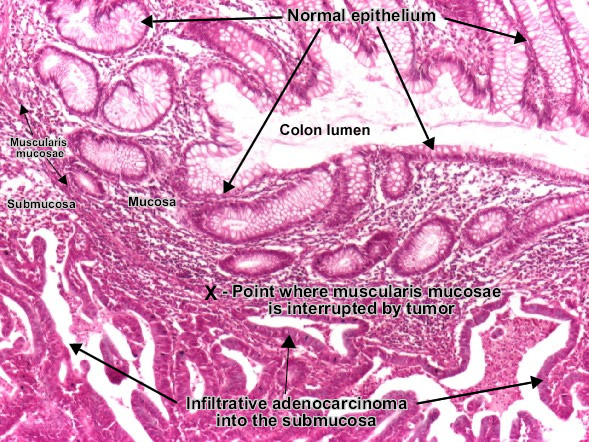 Colon Pathology