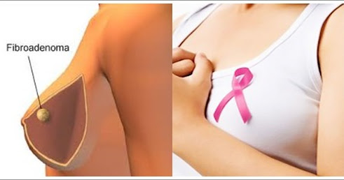 Pengobatan Tradisional Fibroadenoma mammae Terbaru | Pengobatan Tradisional Ejakulasi Dini Ampuh
