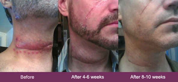 mederma before and after