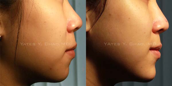 塑顏電波--thermage CPT sculpting, Yates Y. Chao, MD 塑顏電波--thermage CPT sculpting, Yates Y. Chao, MD