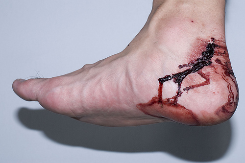 Leech Bites