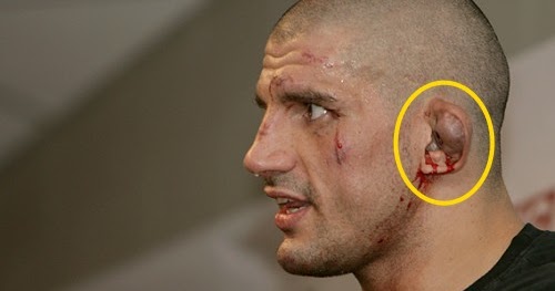 Nocaute-Brasil: Curiosidades sobre a orelha de couve-flor