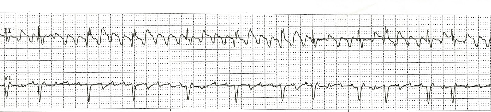 does atrial flutter always turn into afib flutter does atrial flutter always turn into afib flutter