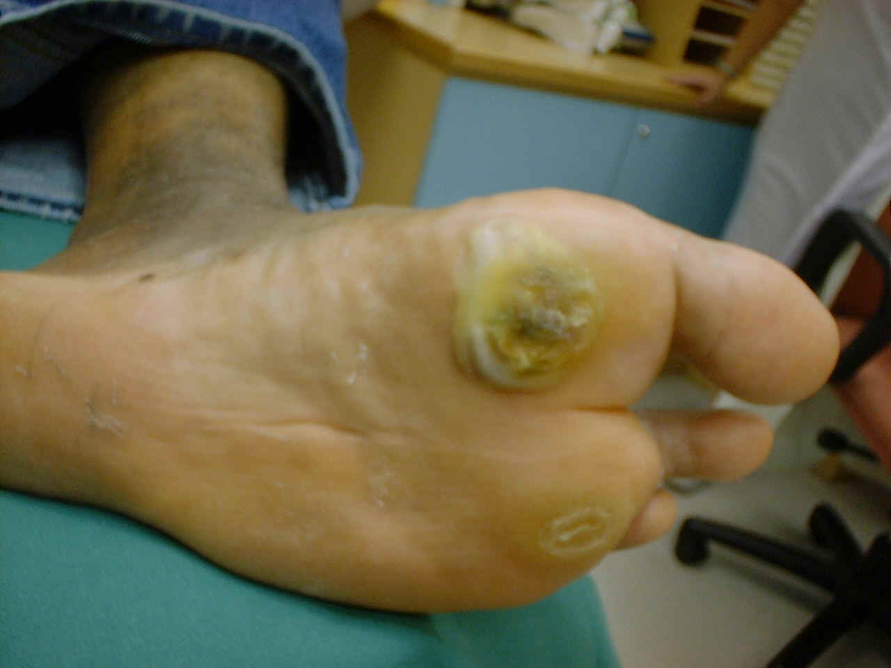Corn Foot Removal