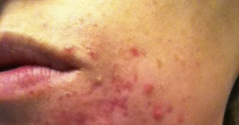 dermatitis perioral acne