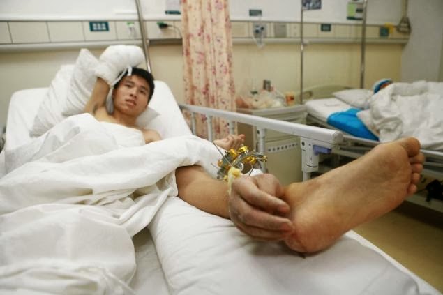 Severed Hand Saved After Being Attached To Man’s Ankle