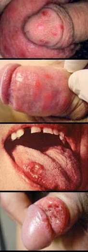sipilis obat sipilis manjur