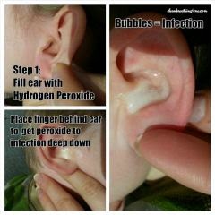 Hydrogen Peroxide to Diagnose and Cure Ear Infections