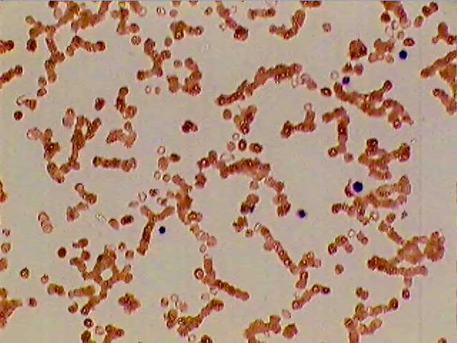 Anemia Aplastika Apa Sih Itu Interesting And Fabulous Things