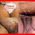 Bintik Bintik Merah Bergelembung di Kelamin thumbnail