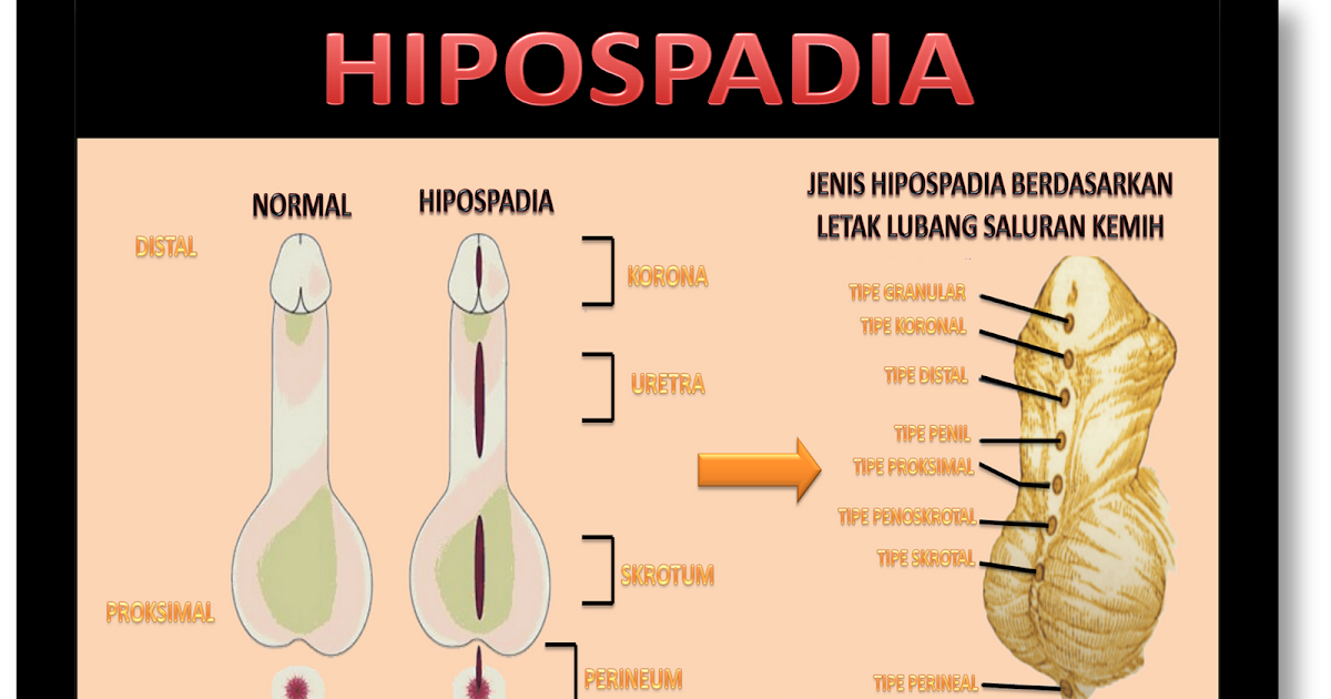 Neonatus Midwifery Hipospadia