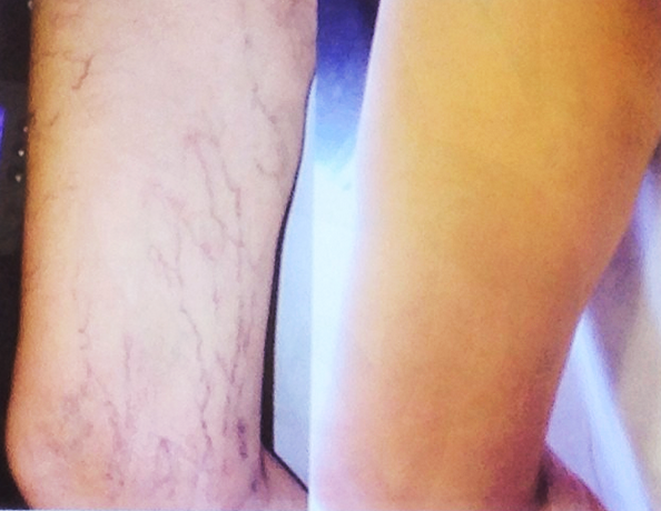 Elimina las varices con Láser Endovenoso con IML Elimina las varices con Láser Endovenoso con IML