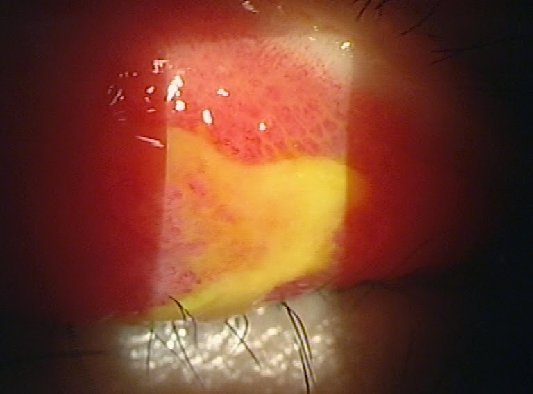 All things eye Por Yong Ming Conjunctivitis What you should do if