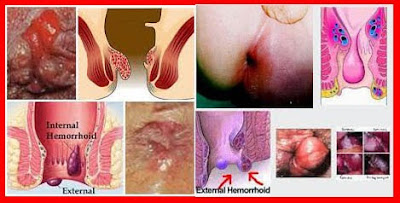 Obat Wasir Sehatku Tradisional Obat Wasir Sehatku Tradisional