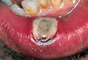Recurrent Aphthous Ulcers ppt Recurrent Aphthous Ulcers3 Recurrent Aphthous Ulcers ppt