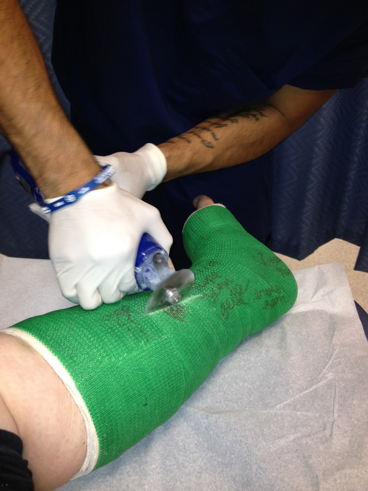 cast foot removal saw hard left cutting using