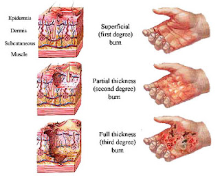 which type of burn is also called a partial-thickness burn