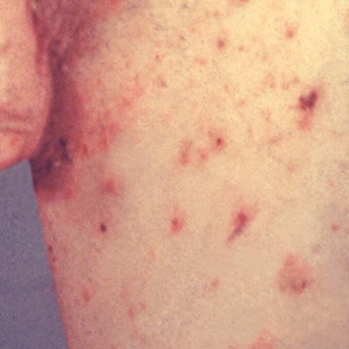 Scabies Pictures Mouade Agafay