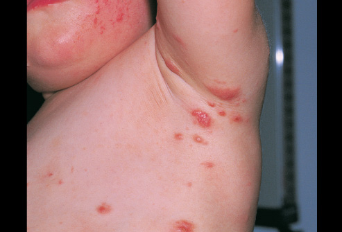 Scabies Pictures Mouade Agafay