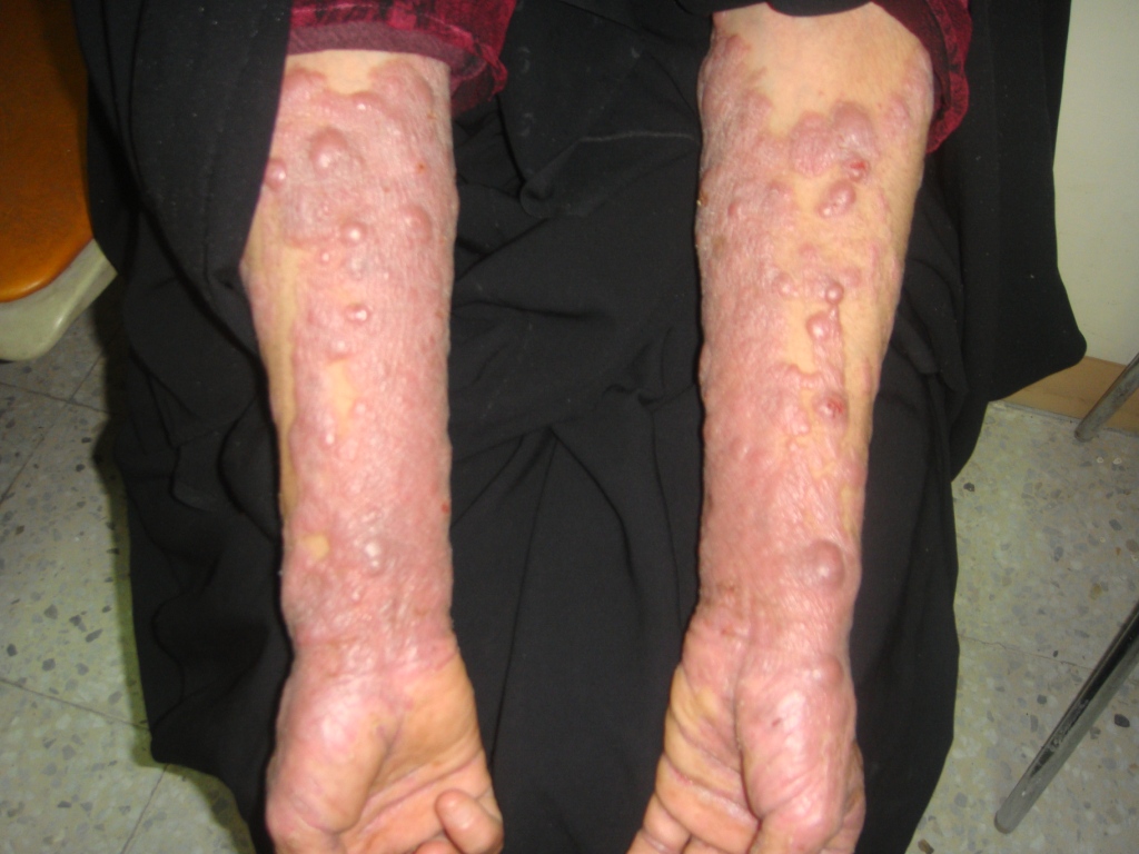 Skin Tumors: Mycosis fungoides
