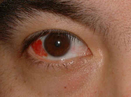 subconjunctival hemorrhage subconjunctival hemorrhage
