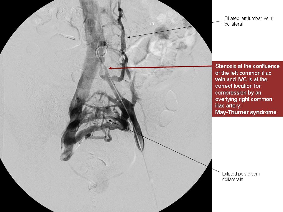 Can May Thurner Syndrome cause symptoms in BOTH legs? Get Healthy Veins