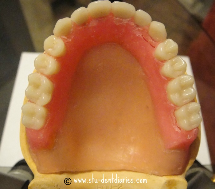 StuDENT Diaries Removable Prosthodontics Complete Dentures