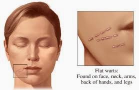 over the counter wart remover