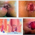Obat Ambeien Cara Tradisional thumbnail