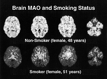 Brain damage due to smoking Brain damage due to smoking