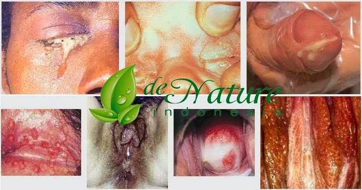 Obat Ampuh Sipilis Resep Dokter Obat Ampuh Sipilis Resep Dokter