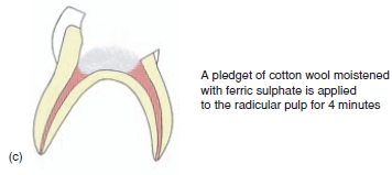 Pulpotomy : Indications and Procedure of pulpotomy image60 Pulpotomy : Indications and Procedure of pulpotomy
