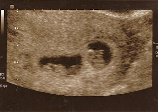 First scan revealing twins