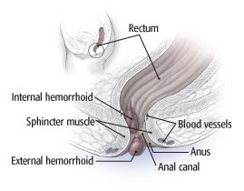 Internal Hemorrhoids Symptoms