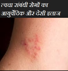 चर्म रोग की बीमारी में लाभकारी औषधि  Ayurvedic Treatment of Skin Problems in Hindi , त्वचा संबंधी रोगों का स्थाई इलाज, होम रेमेडीज फॉर स्किन diseases, 