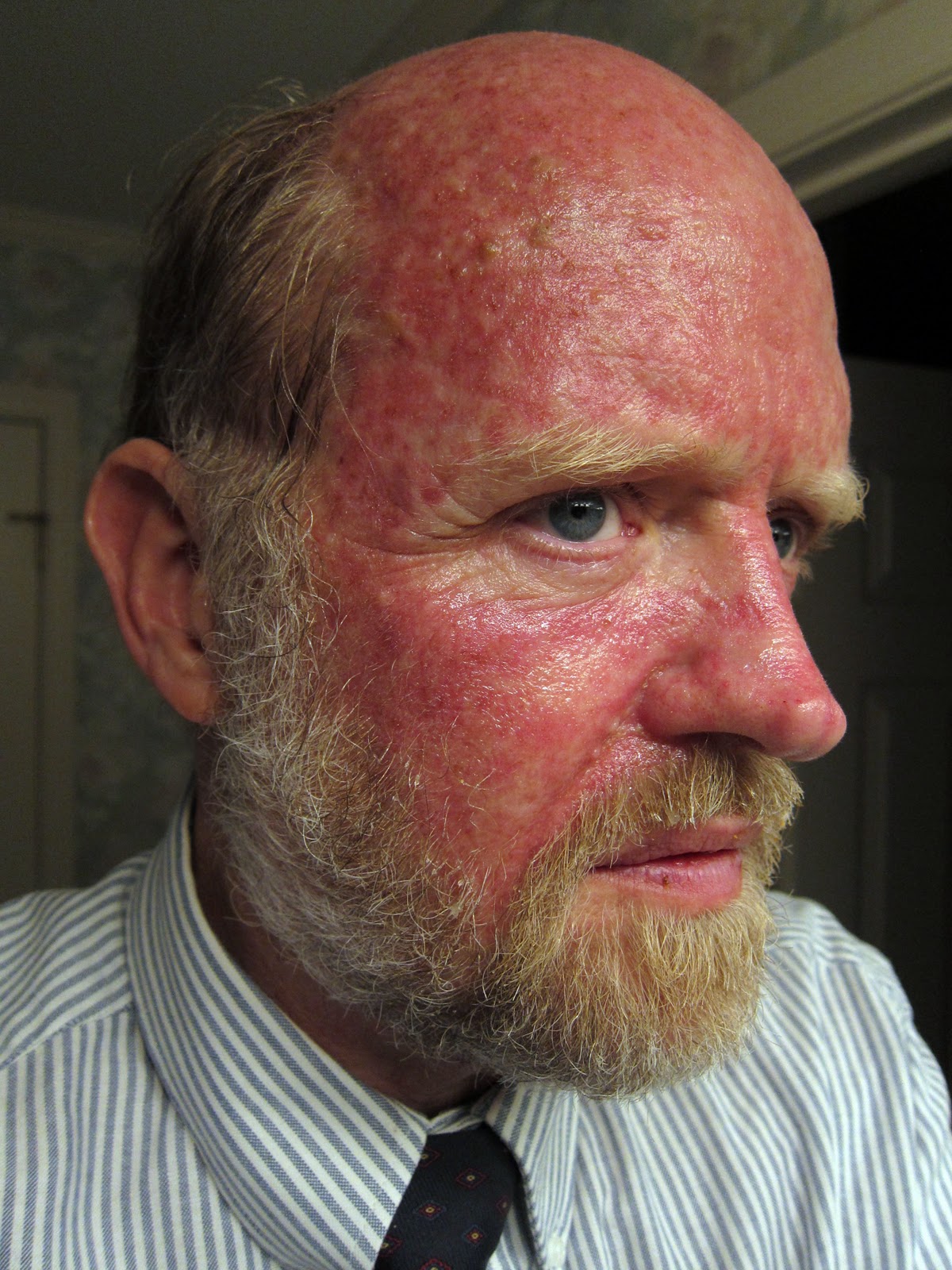 Efudex Round Two Day 15 (Recovery Day 1) Ouch!