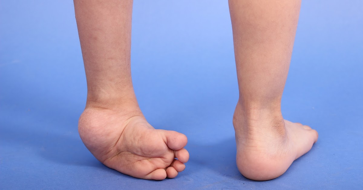 Articulos de interes para Empresas y Pymes Método Ponseti y el pie