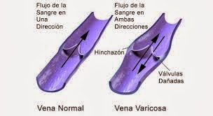 como prevenir la formacion de las venas varicosas